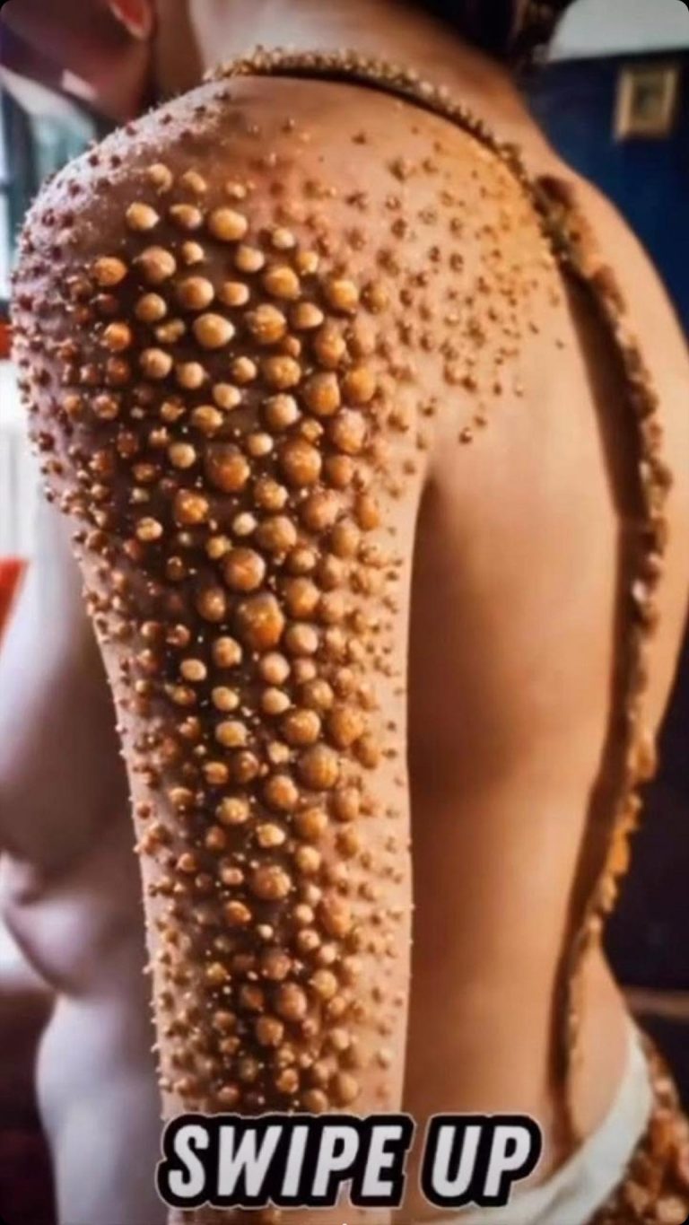 Body Acne: 4 Tips To Get Rid Of Them
