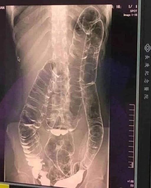 Severe Constipation and Toxic Megacolon: Causes and Solutions