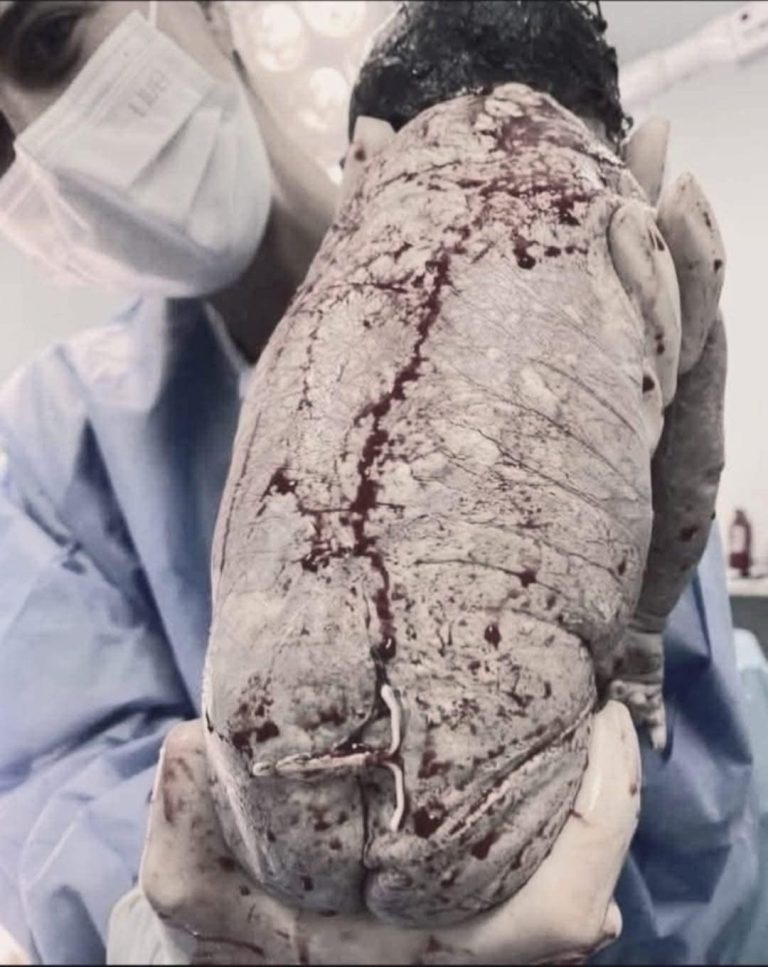 😱😱Baby born with an DIU peg… See more